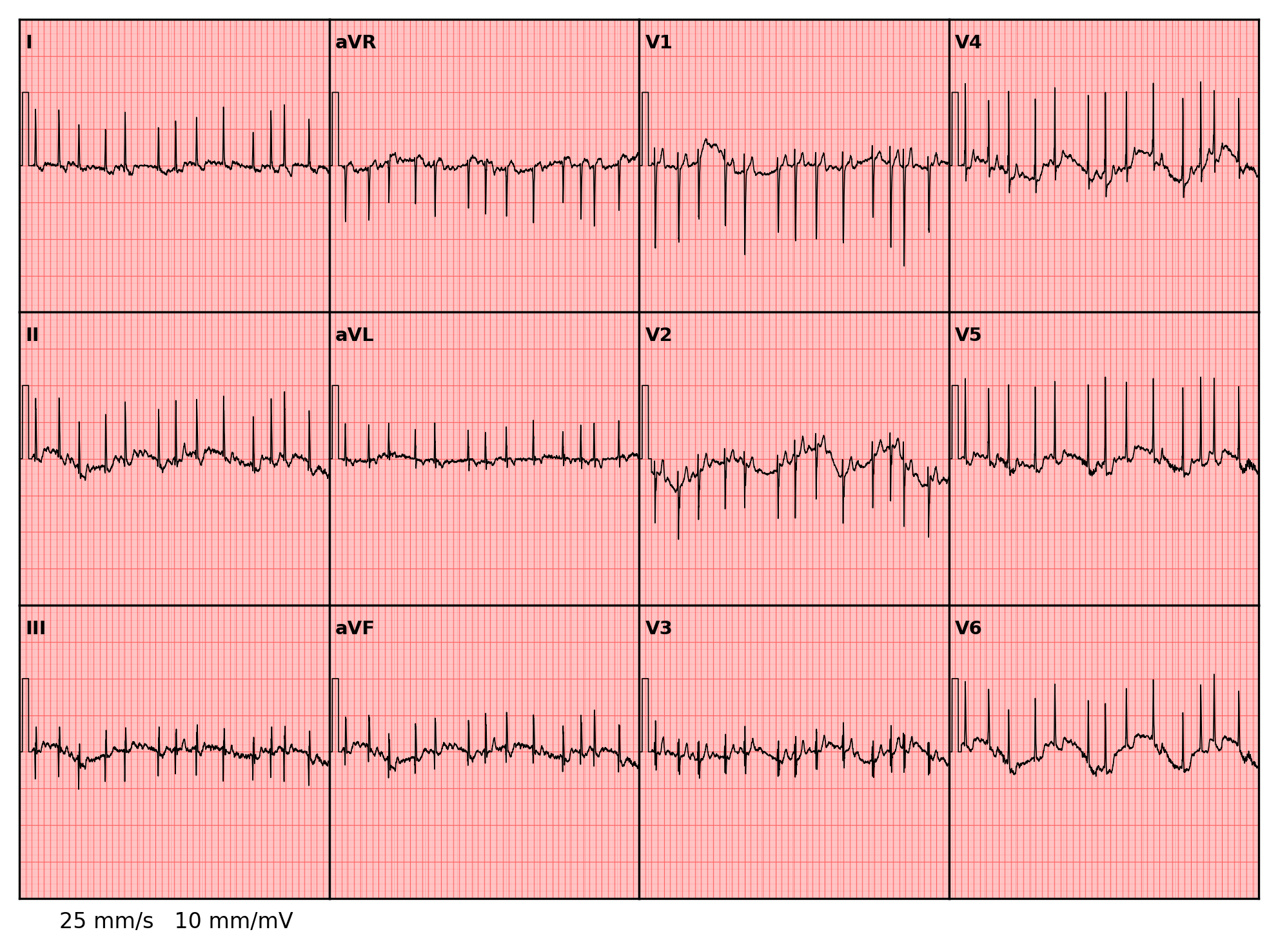 ../../_images/examples_recipe_plot_ecgs_10_0.png