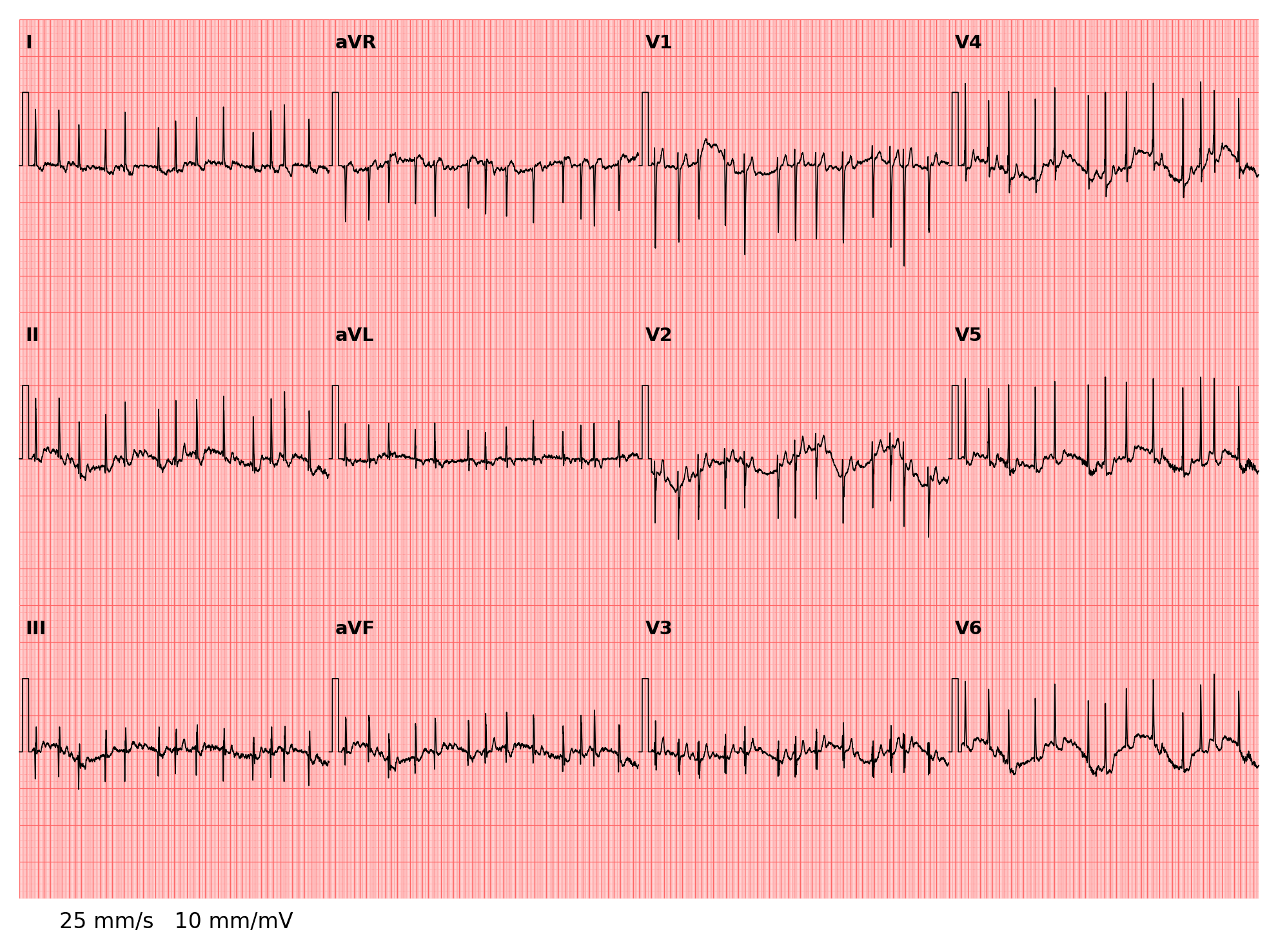 ../../_images/examples_recipe_plot_ecgs_11_0.png