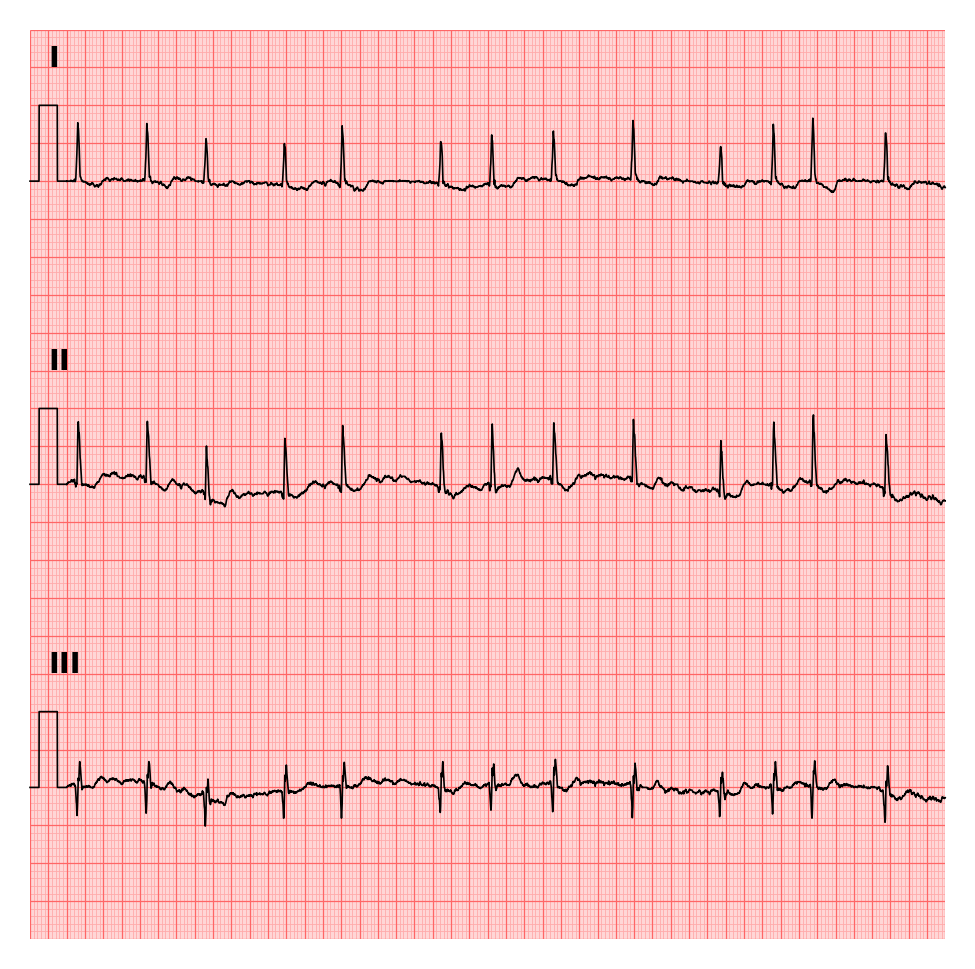 ../../_images/examples_recipe_plot_ecgs_13_1.png