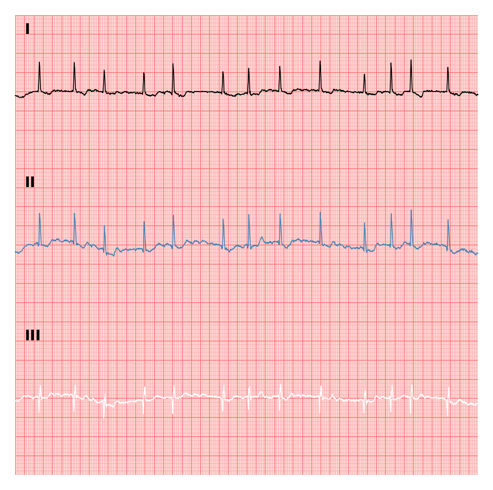 ../../_images/examples_recipe_plot_ecgs_15_1.png