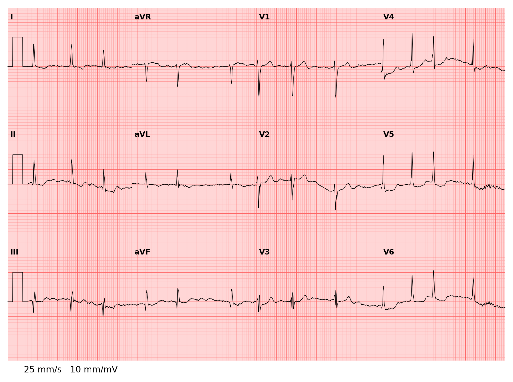 ../../_images/examples_recipe_plot_ecgs_17_0.png