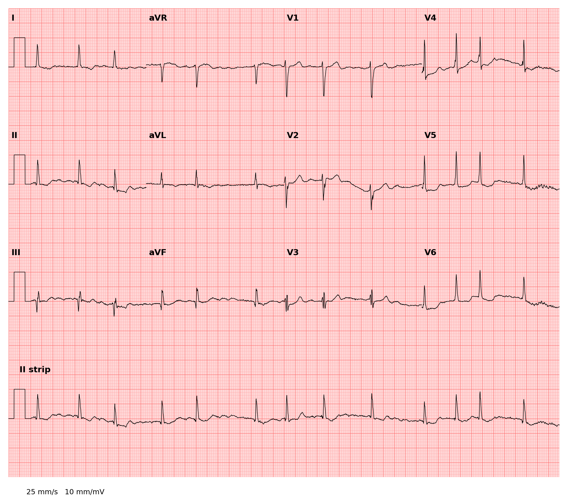 ../../_images/examples_recipe_plot_ecgs_19_0.png