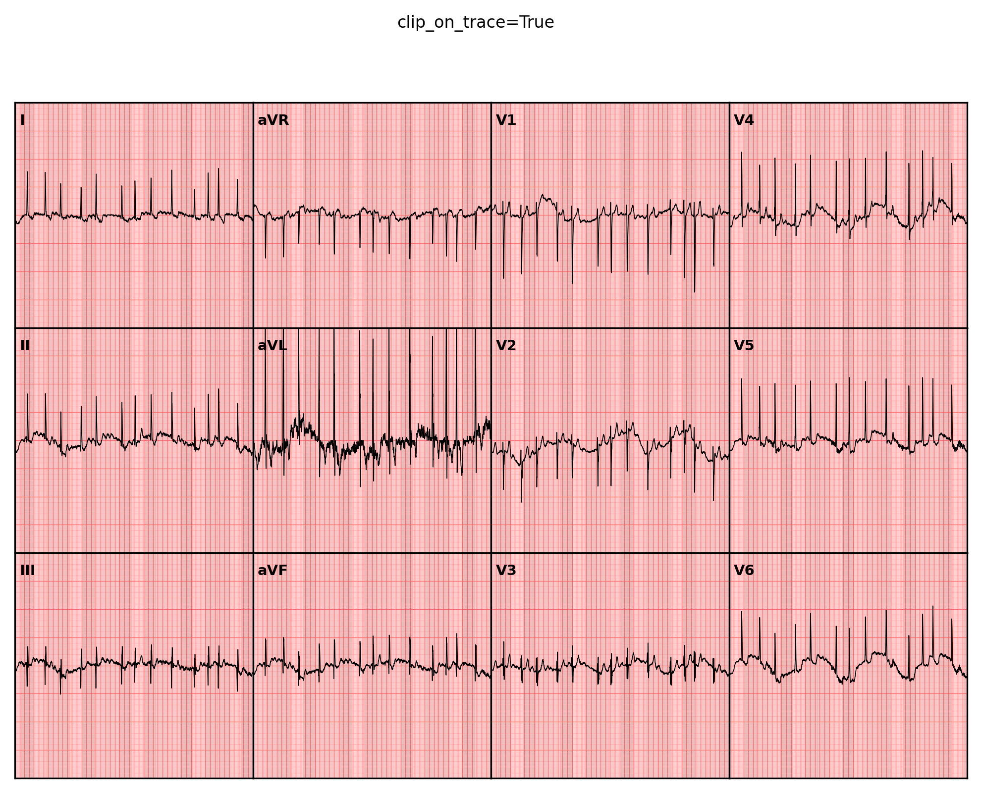 ../../_images/examples_recipe_plot_ecgs_21_0.png