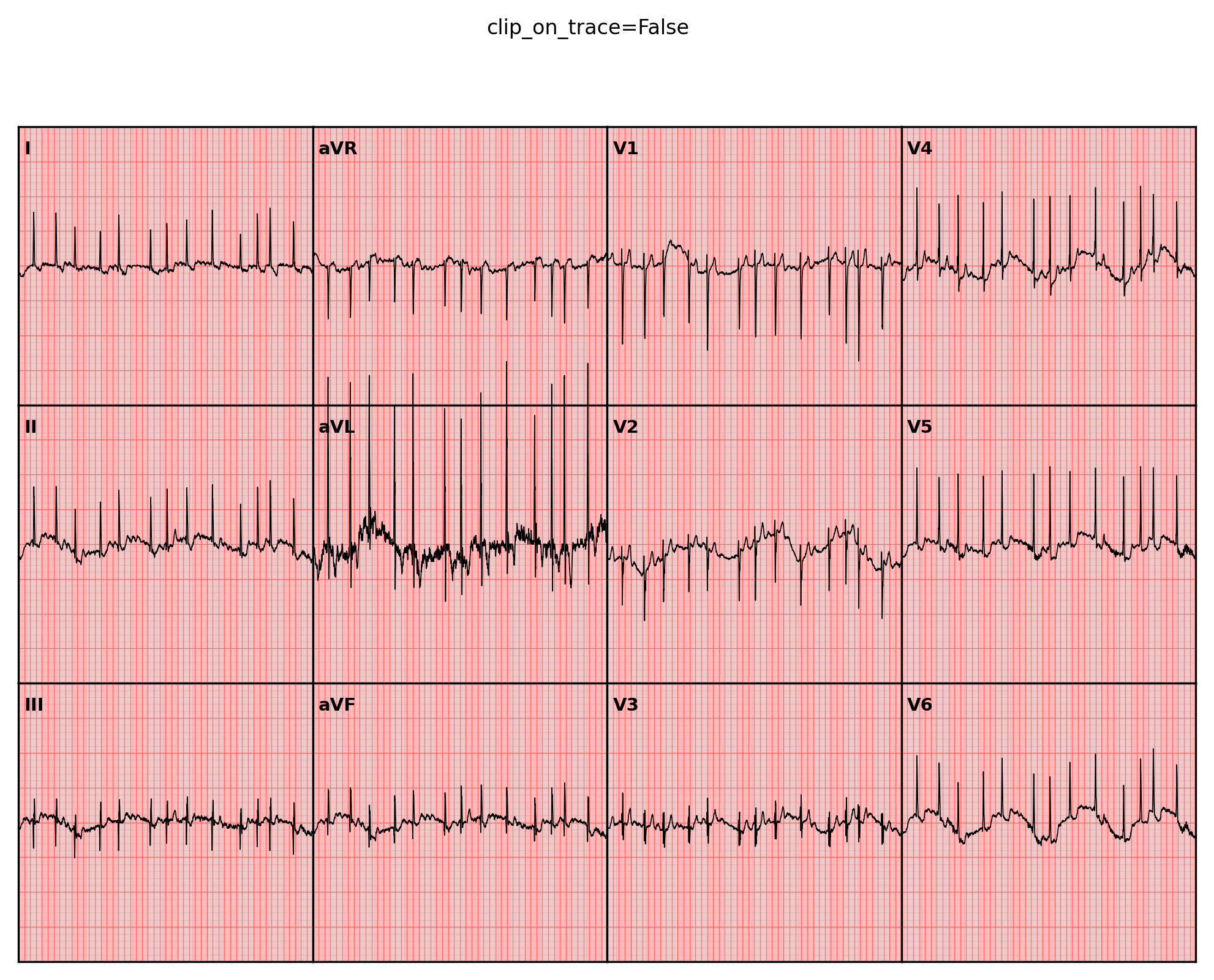 ../../_images/examples_recipe_plot_ecgs_21_1.png