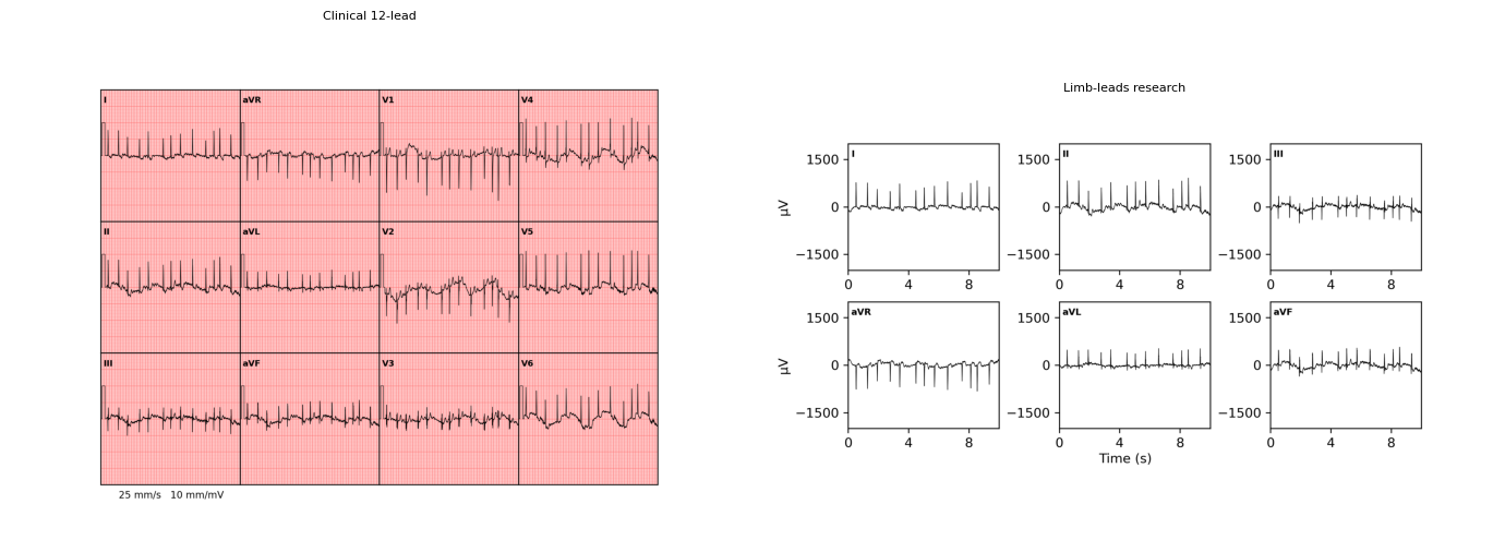 ../../_images/examples_recipe_plot_ecgs_28_0.png
